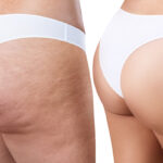 Cellulite anche con lo sport, alcune considerazioni importanti